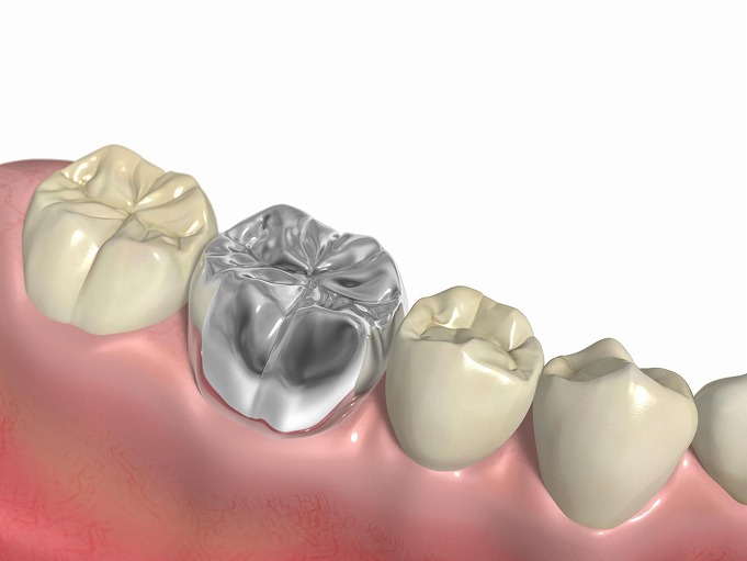 銀歯が気になってしまう方